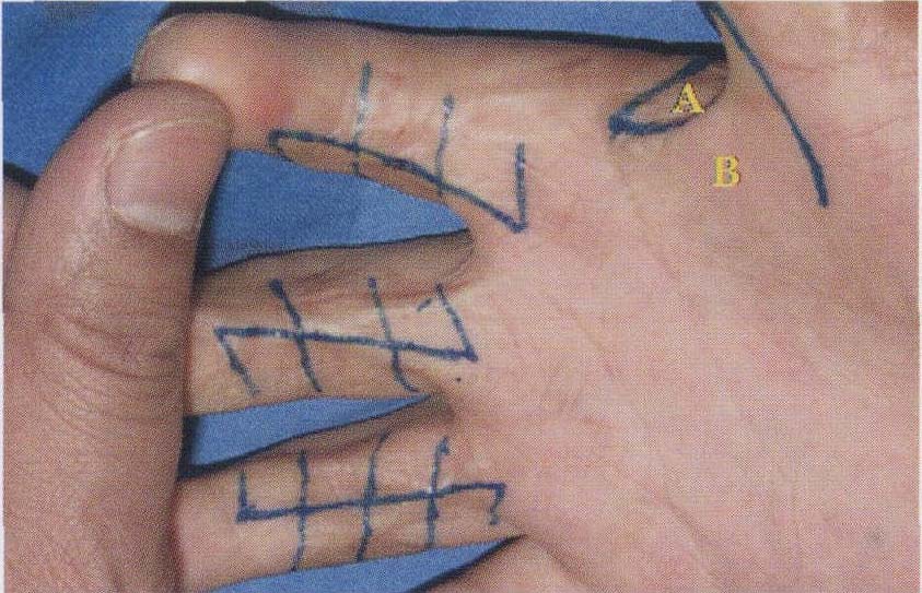 典型病例2:单z和连续z成形术矫正右手虎口瘢痕性狭窄和2～4指瘢痕挛缩